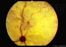10. Hemorragia focal de retina