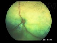 16. desprendimiento ventral de retina