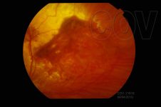 17. Hemorragia retina