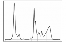 5-Proteinograma de un gato con Artritis inmunomediada