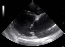 8. POCUS eje largo