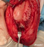 Clave 3 - Detalle de una rodilla con artrosis secundaria a una rotura del ligamento cruzado anterior