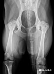 Clave 4 - La microfractura de osteofitos periarticulares puede generar una crisis artrítica en una articulación que mantenía una artrosis semisintomática.