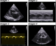 Figura 2 Ecocardiografia en un gato con hipertensión