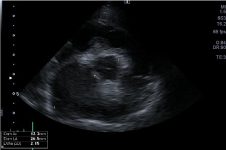 figura 12A Ecocardiografia Ratio AI_Ao